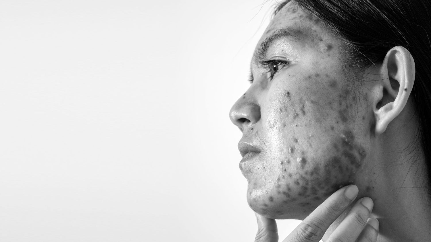 The Acne That Won't Go Away: Understanding Hormonal Breakouts